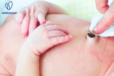 Cha mẹ nên làm gì khi phát hiện nhiễm trùng rốn trẻ sơ sinh?